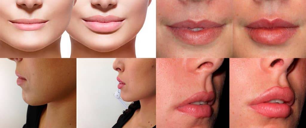 Парижские (французские) губы: техника увеличения, фото до и после