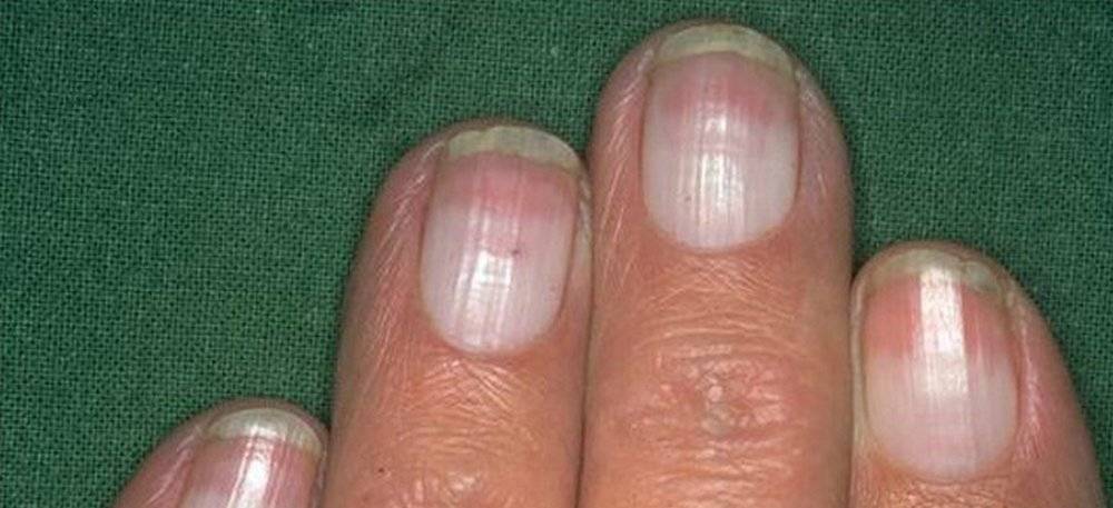 Ребристая поверхность ногтей: почему появляется, как ее восстановить?