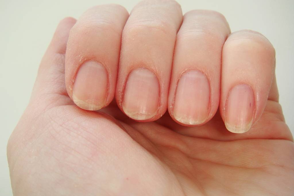 Шелушение и трещины кожи пальцев на руках: причины и лечение
