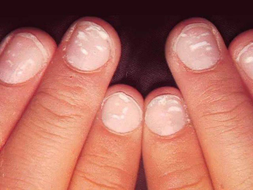 Диагностика по ногтям: как определить заболевание по ногтевой пластине