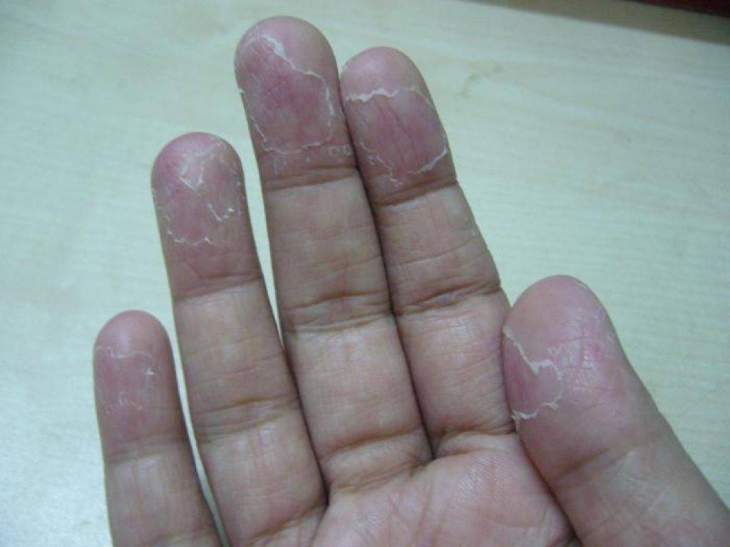 Причины, из-за которых облазит кожа на пальцах рук: симптомы и лечение в домашних условиях