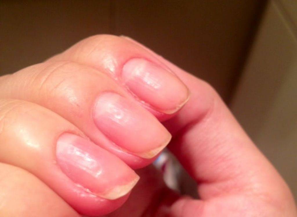 Почему ногти становятся бугристыми, волнистыми и ребристыми? причины деформации, лечение и профилактика проблемы