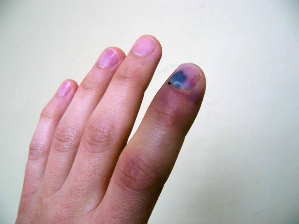 Травма ногтя – необходимые действия