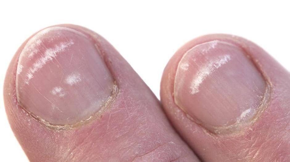 На ногтевой пластине белые пятна у грудничка. почему появляются белые полоски на ногтях: лечение