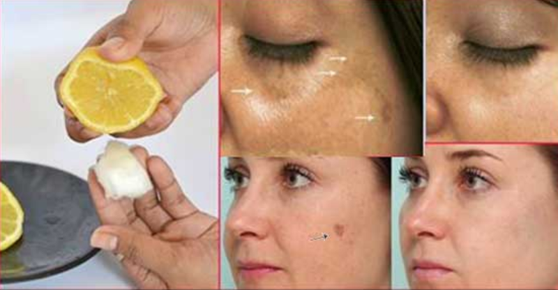Лечение шрамов и рубцов на лице и теле - способы борьбы с несовершенствами