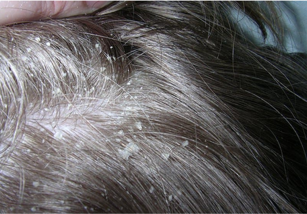 Лечение сухой себореи кожи головы