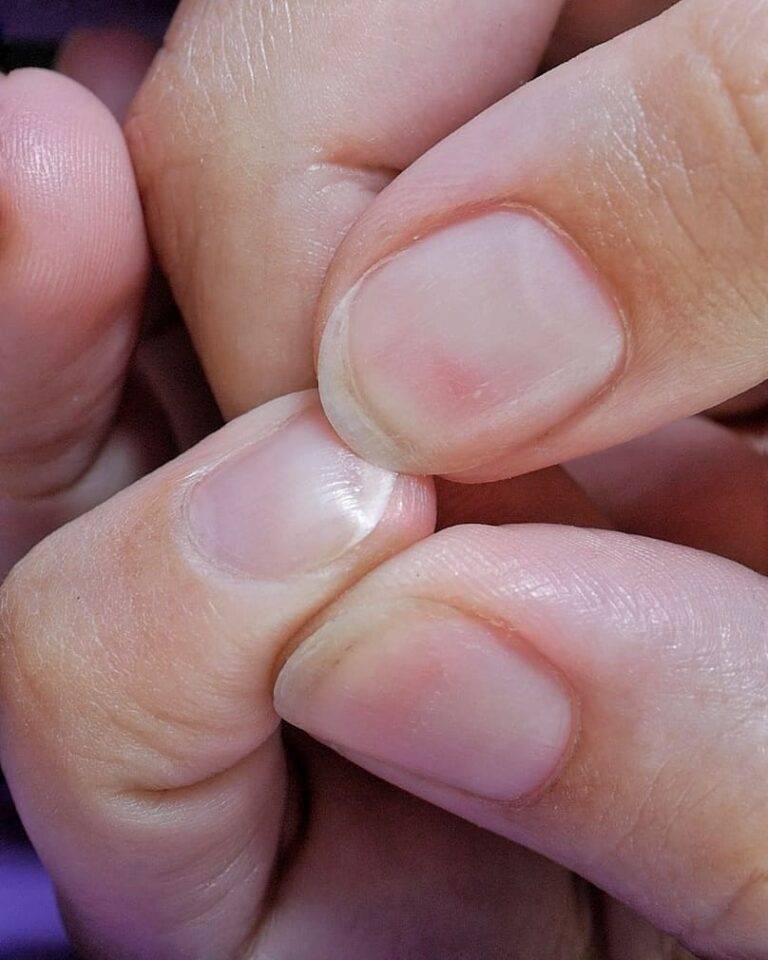 Причины слоящихся ногтей на руках