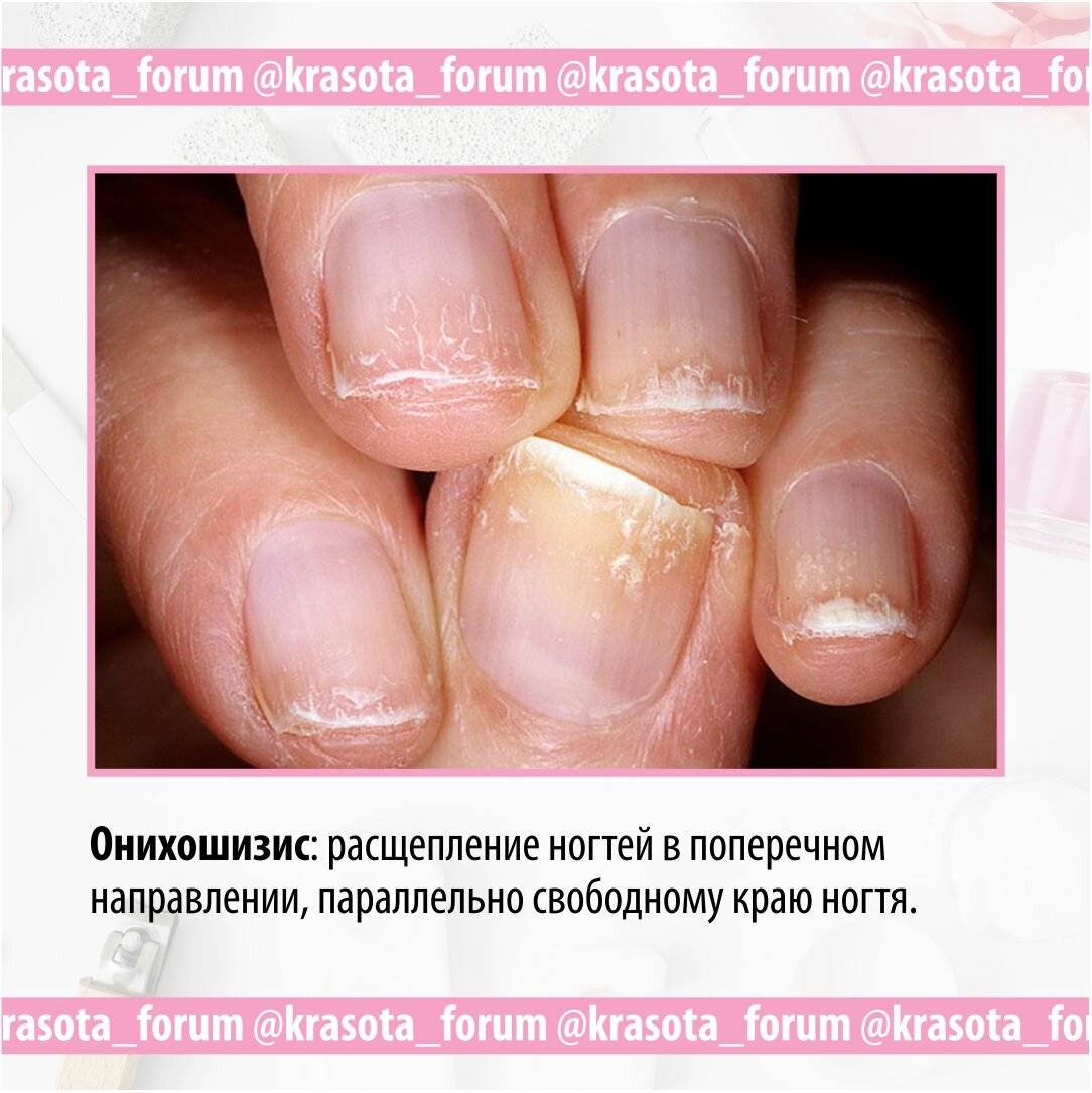 Что такое медицинский педикюр?