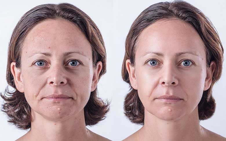 Аппаратная биоревитализация кожи лица