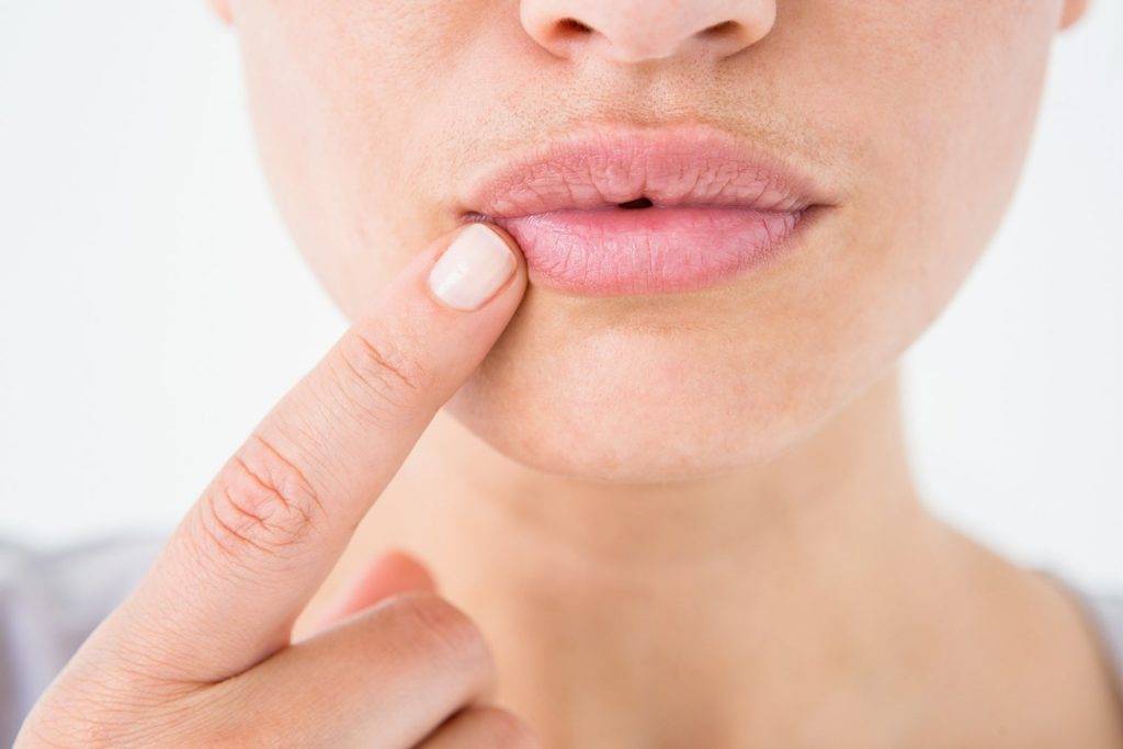 Раздражение в уголках губ: причины и лечение ангулита или известных всем «заедов»