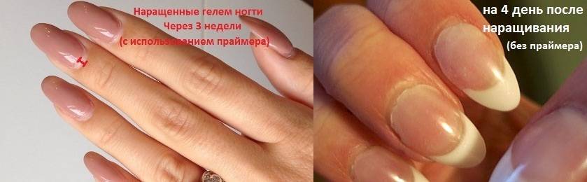 Онихорексис или трещина вдоль ногтя