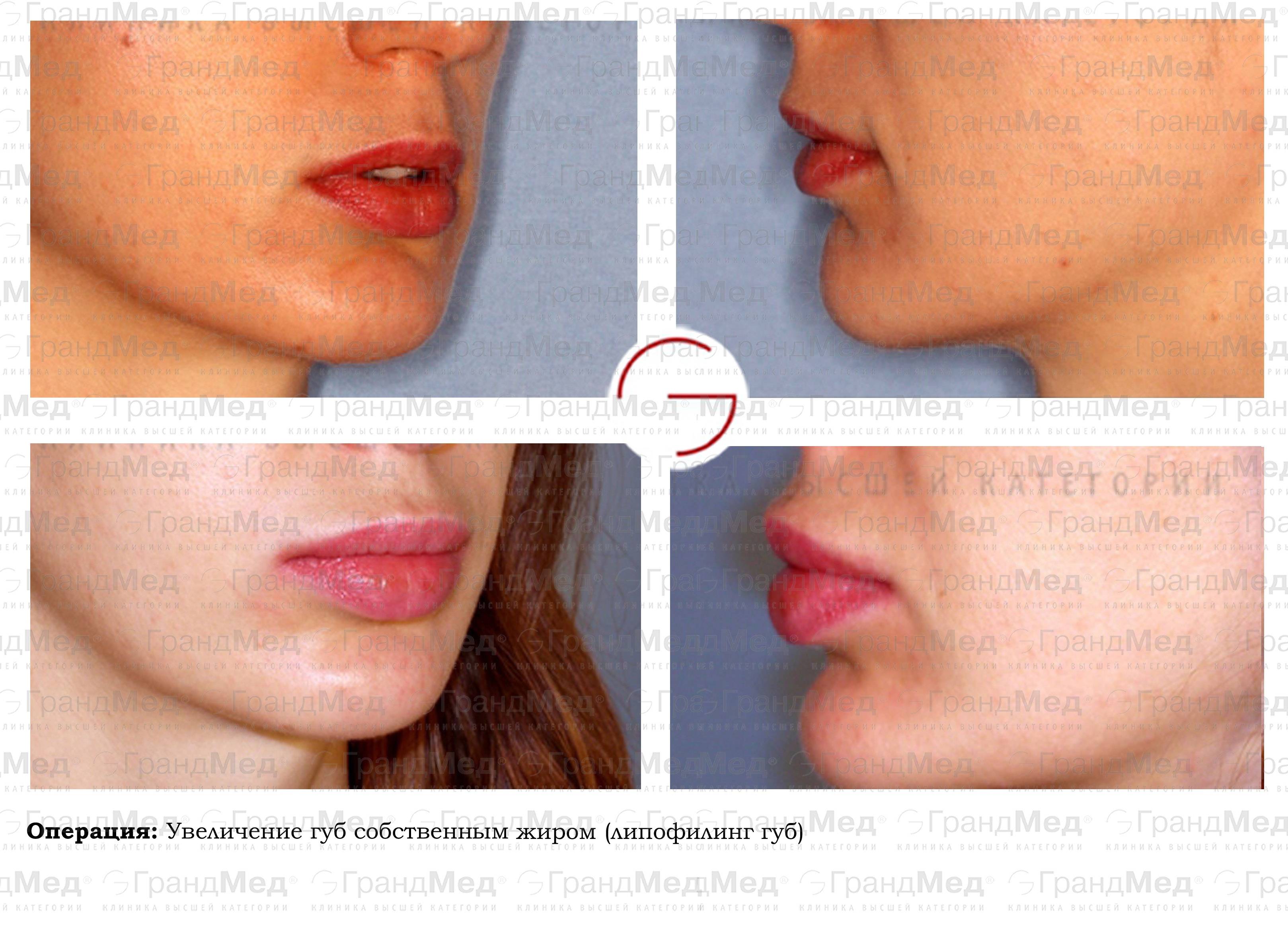 Биоревитализация губ это омоложение кожи губ