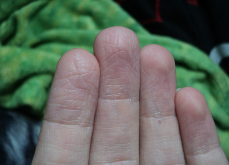 Ковидные пальцы – синдром ковидных пальцев