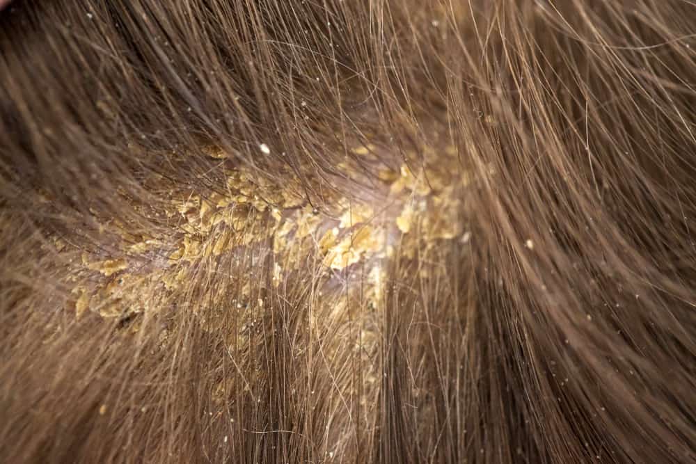 Быстро жирнеют волосы, что делать? ️ в клинике элласес - трихолог в днепр