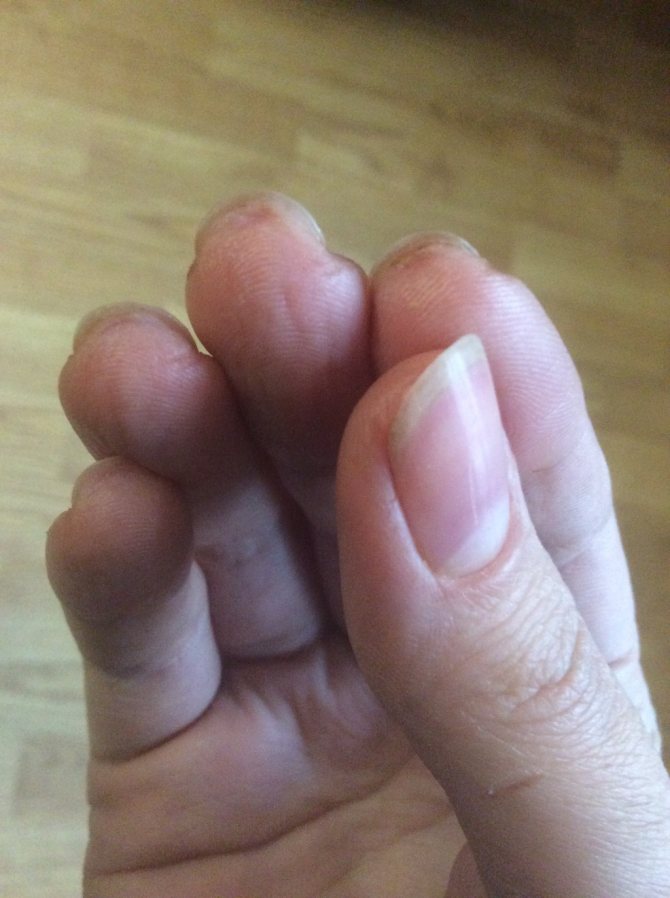 Почему трескается кожа на пальцах рук: причины и лечение