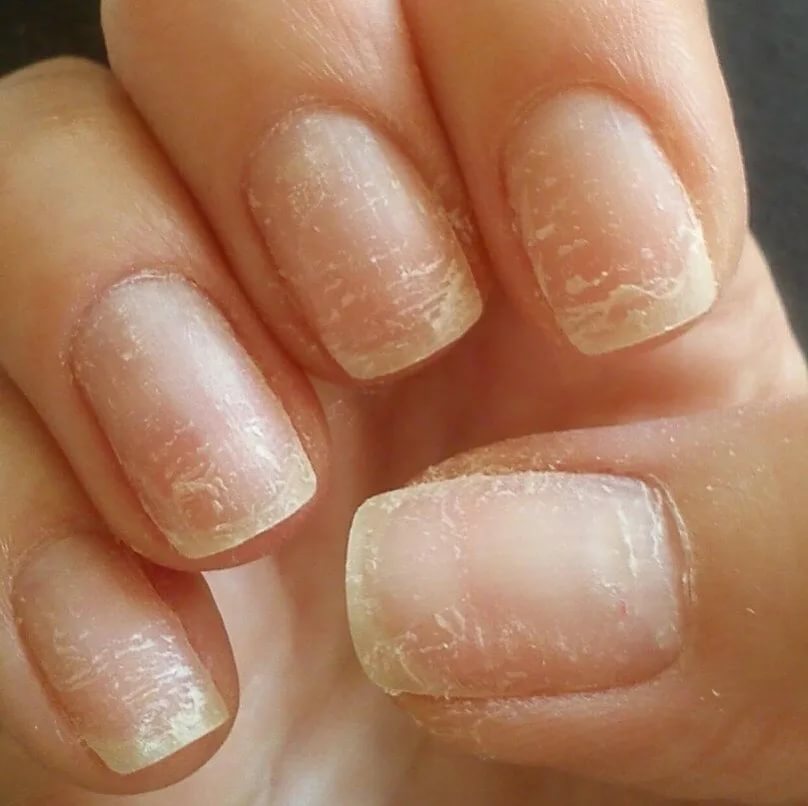 Проблема ногтей: как восстановить их после длительного покрытия шеллаком