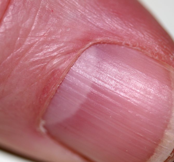 Утолщение ногтей на больших пальцах ног: что делать, почему становятся толстыми, деформация пластины на мизинце - причины и лечение