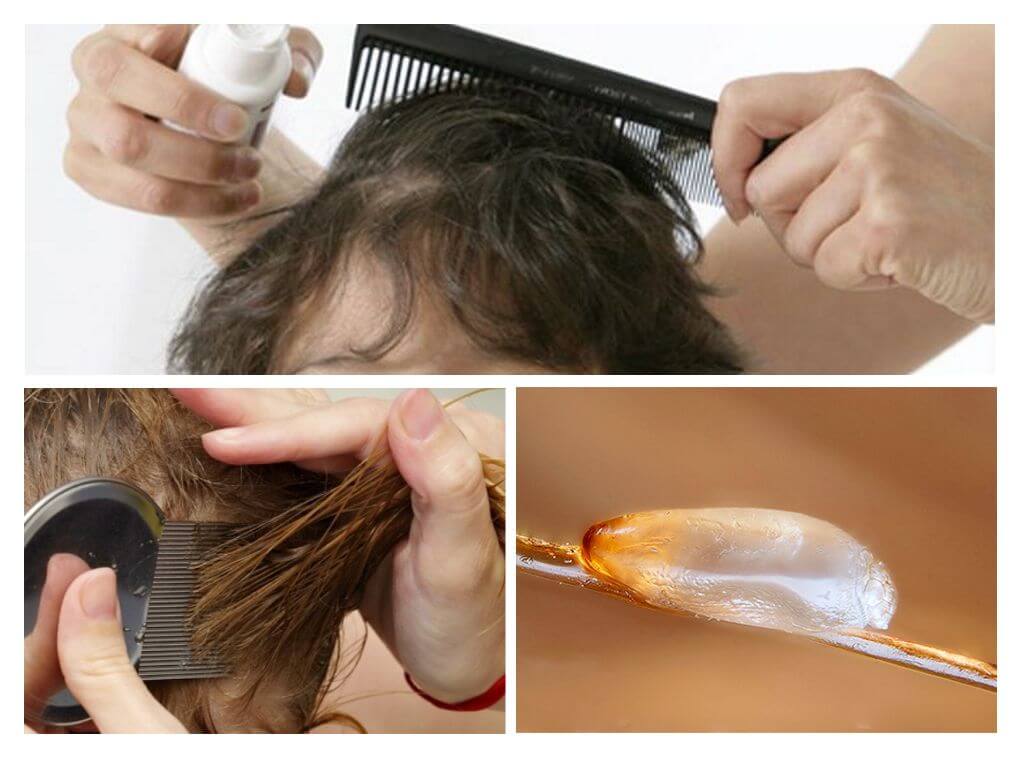 Выпадают ли волосы от гнид