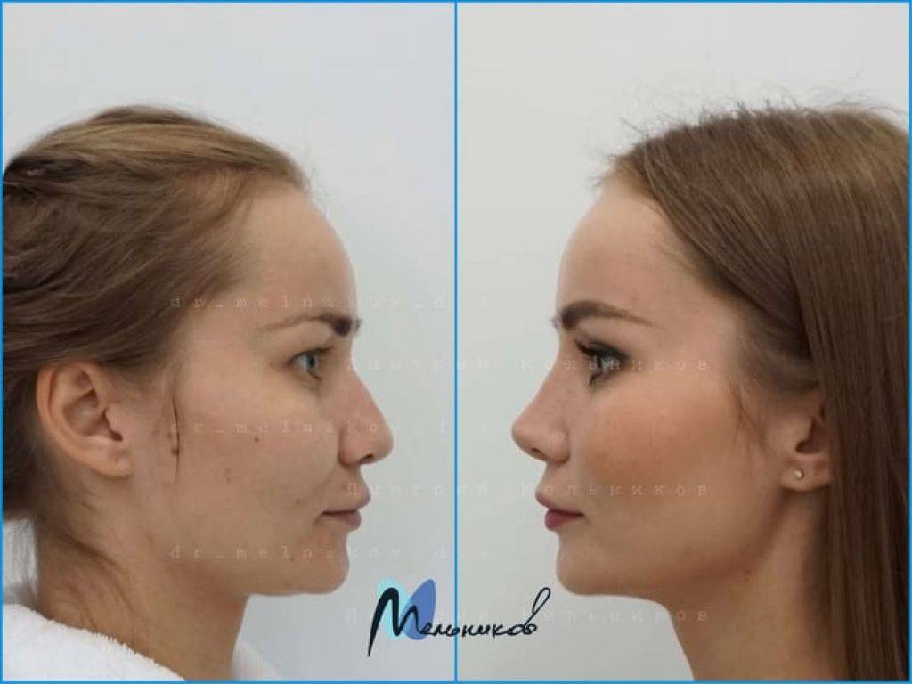 Правильная форма носа у женщин фото