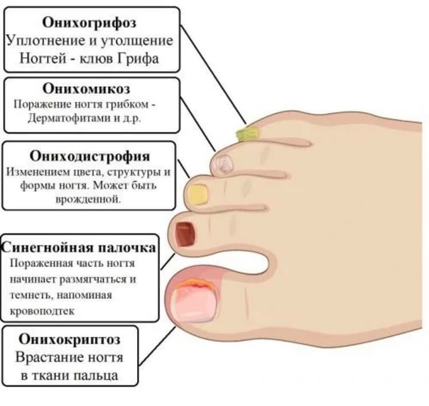 Схема лечения грибка ногтей на ногах у взрослых