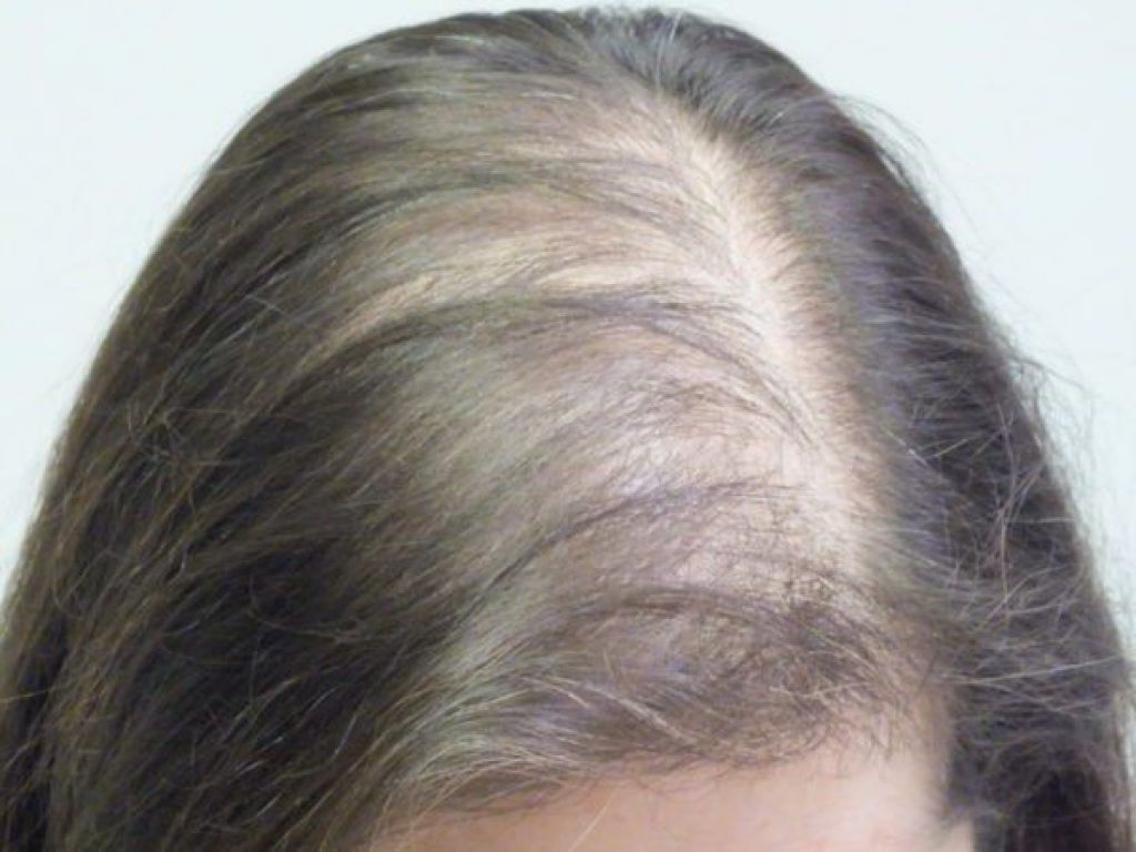 Основные виды алопеции (выпадения волос) и причины алопеции