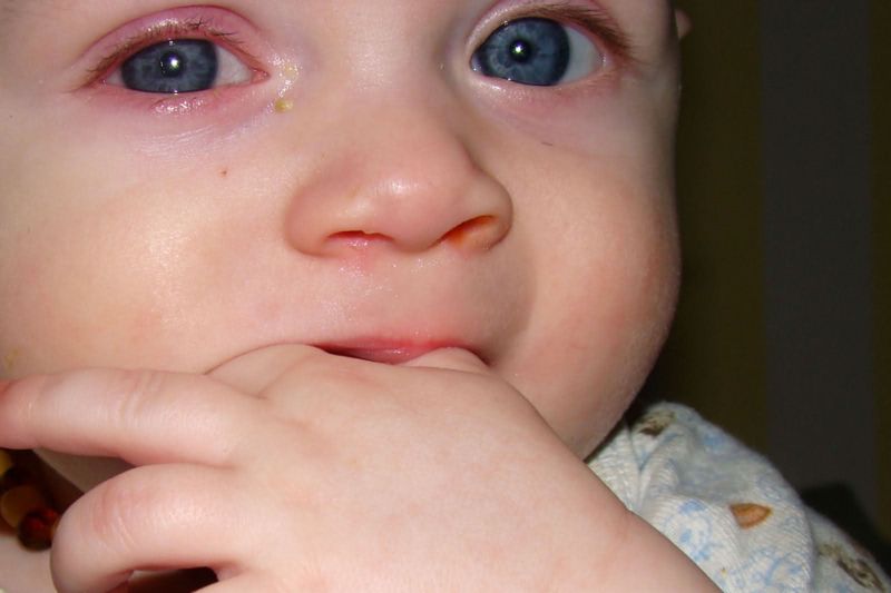 Воспаление глаза у ребенка - детский конъюнктивит
