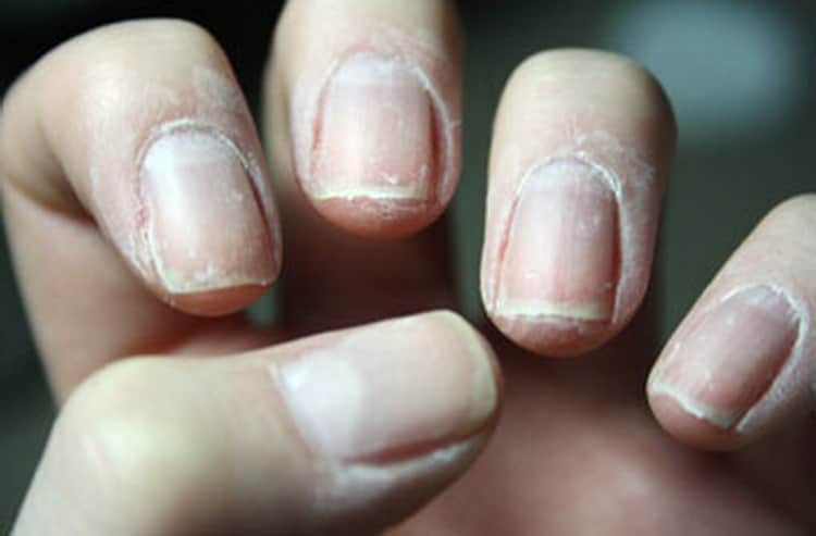 Как восстановить ногти после наращивания: лечебные лаки и составы, домашние средства, салонные процедуры, витамины