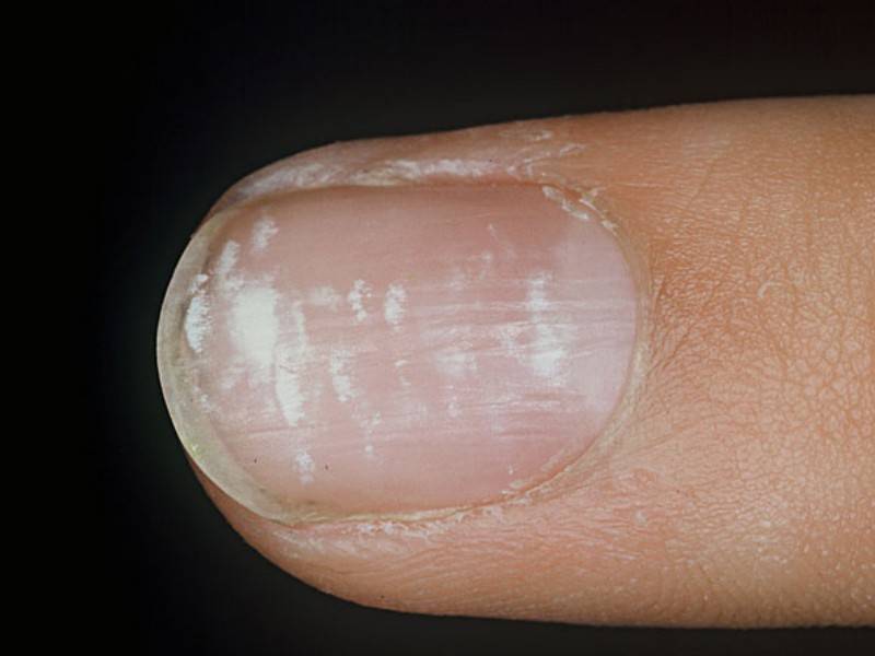 Белые пятна на ногтях: причины, симптомы, диагностика, лечение, профилактика