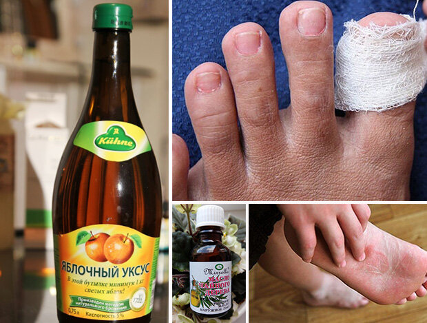 Лечение грибка ногтей уксусом: лучшие рецепты