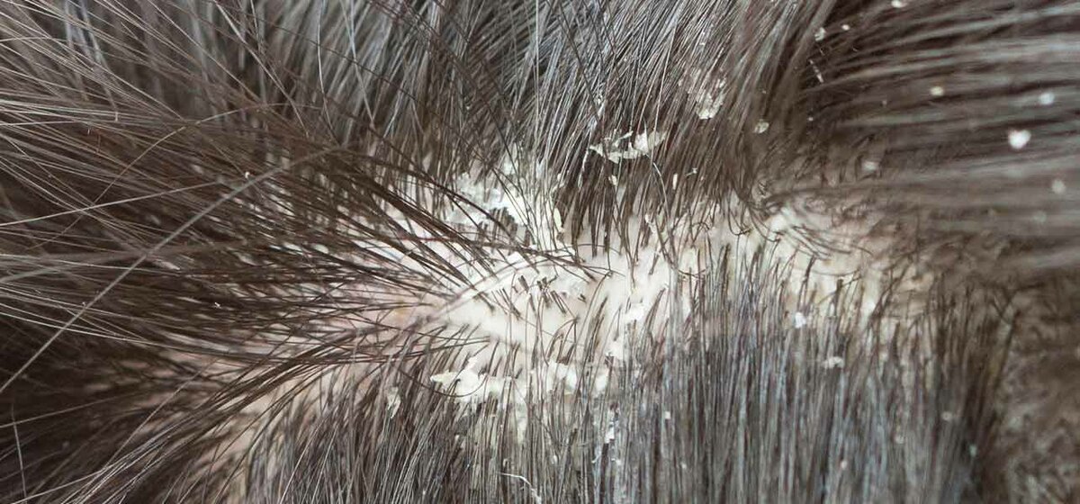 Лечение себореи волосистой части головы