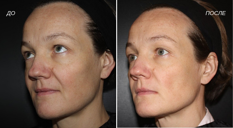 Аквашайн биоревитализация * отзывы косметологов с фото до и после клиентов