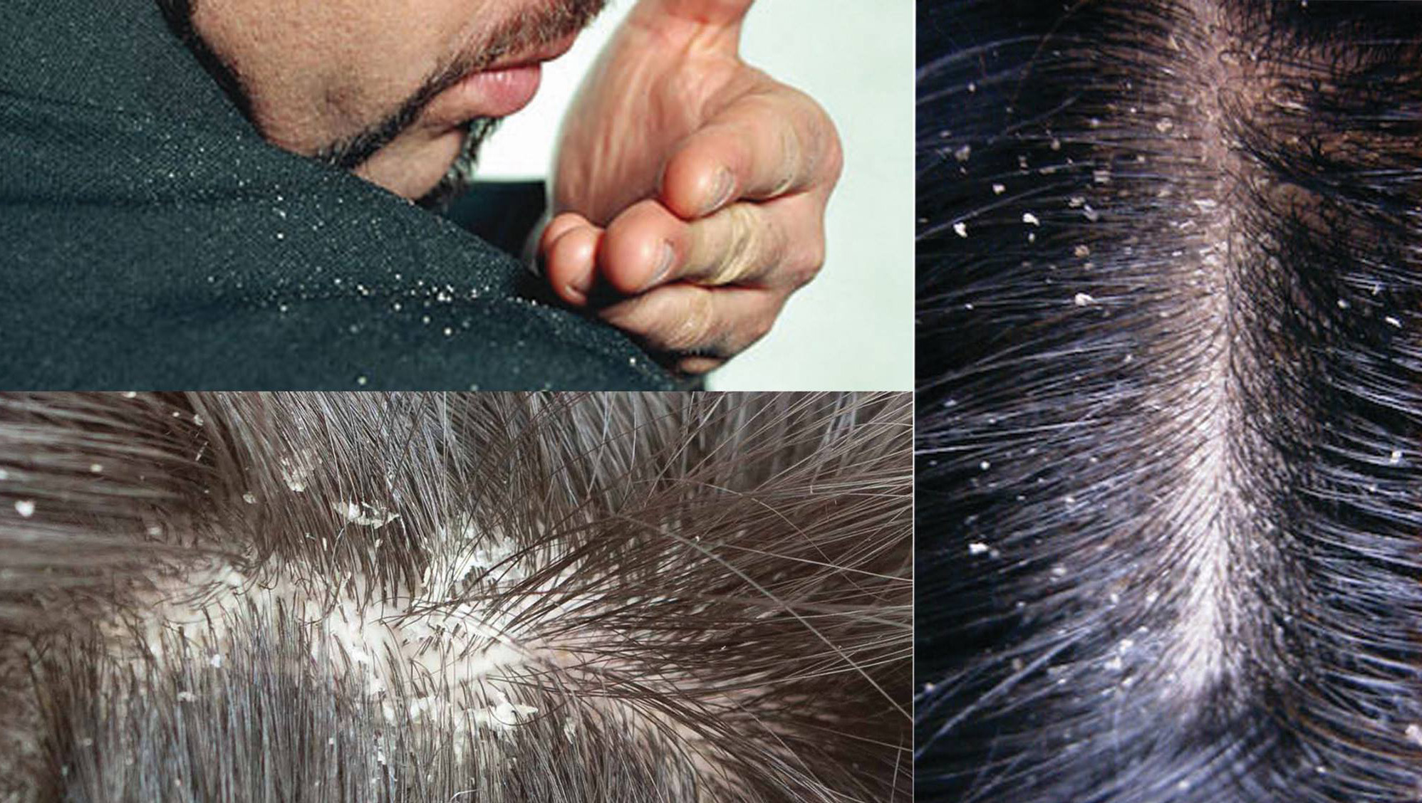 Прыщи на голове у женщин в волосах: гормональные причины, чем лечить | романов георгий никитич