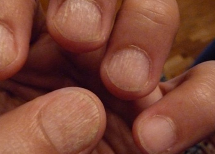 О чем говорят волнистые и бугристые ногти?