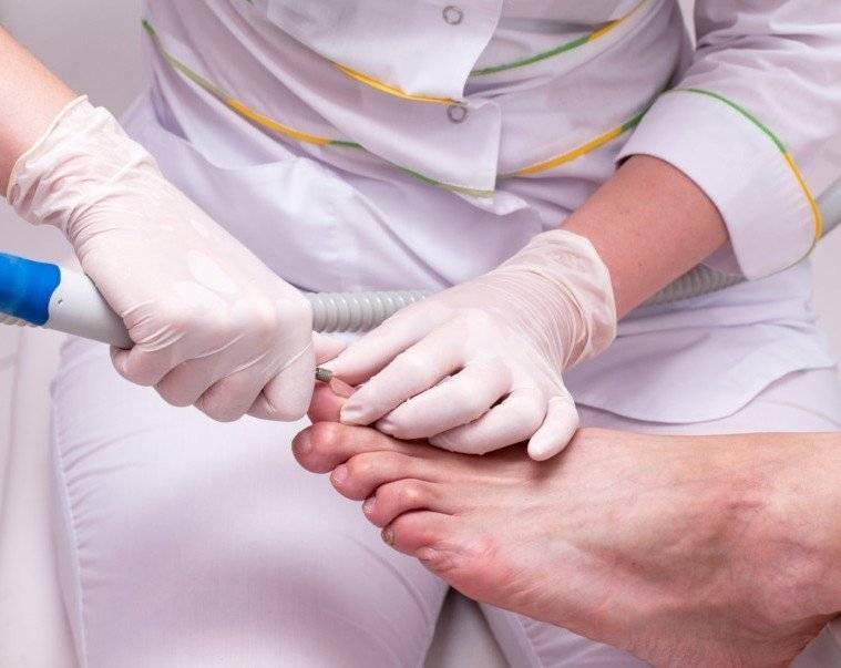 Лечение грибка ногтей на ногах: местная и комбинированная терапия