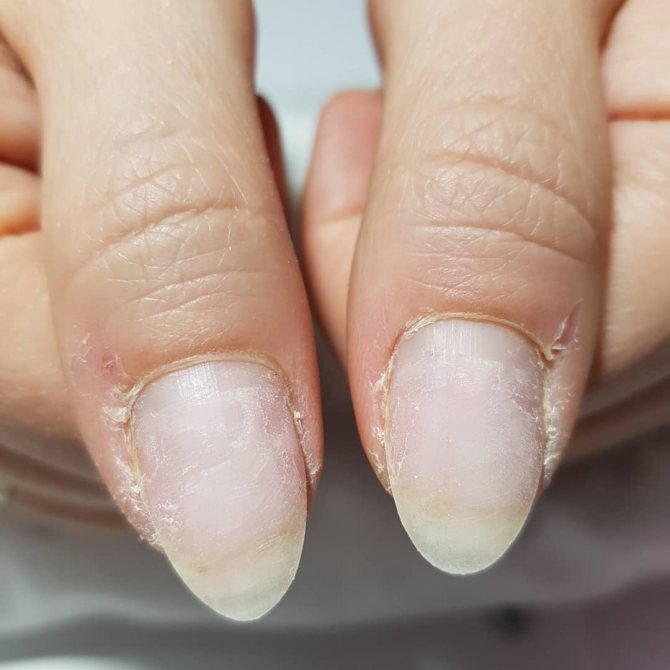 Заусенцы на пальцах: причины, профилактика и лечение