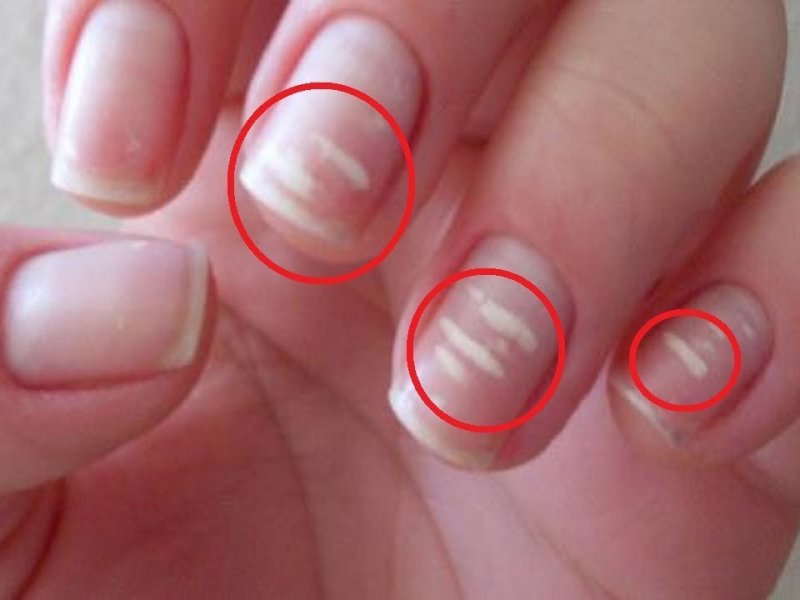 Как лечить белые пятна на ногтях пальцев рук: причины появления, способы лечения и простые профилактические меры