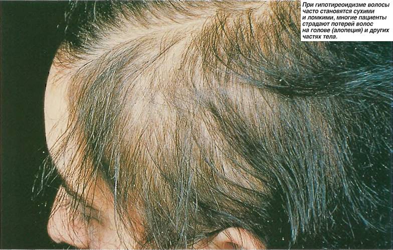 Основные причины выпадения волос у женщин у мужчин