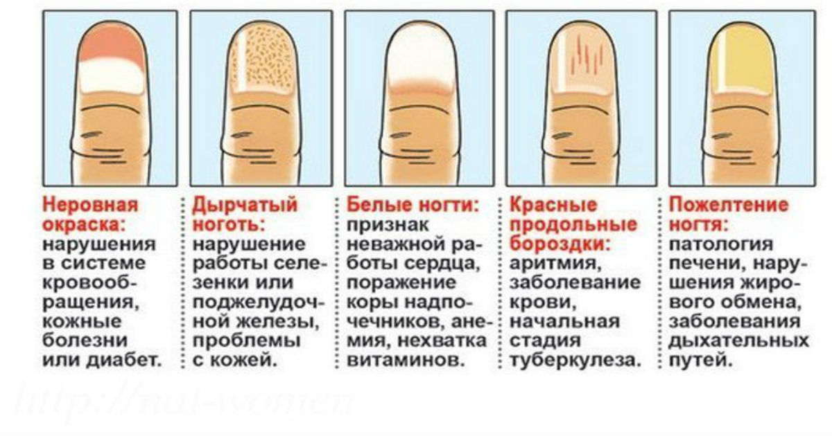 Причины появления черных полосок на ногтях
