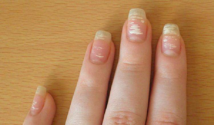 Белые пятна на ногтях пальцев рук - причины появления
