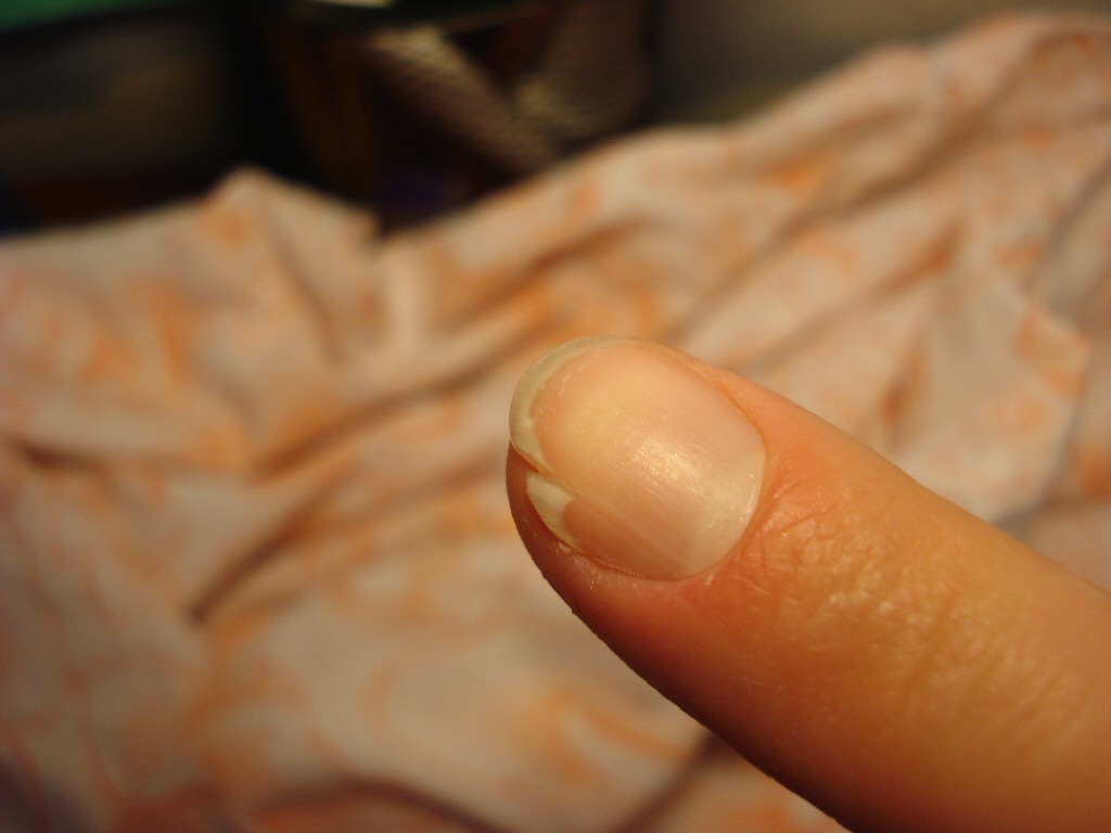 Продольные трещины на ногтях рук (посередине, по краям) – infoklan.ru – женский журнал о красоте