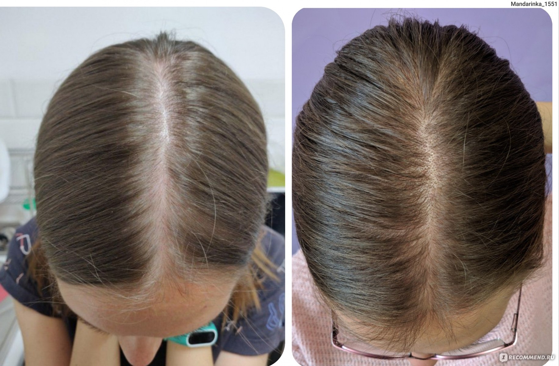 «раньше такого не видели»: врач-трихолог – об особенностях постковидного выпадения волос