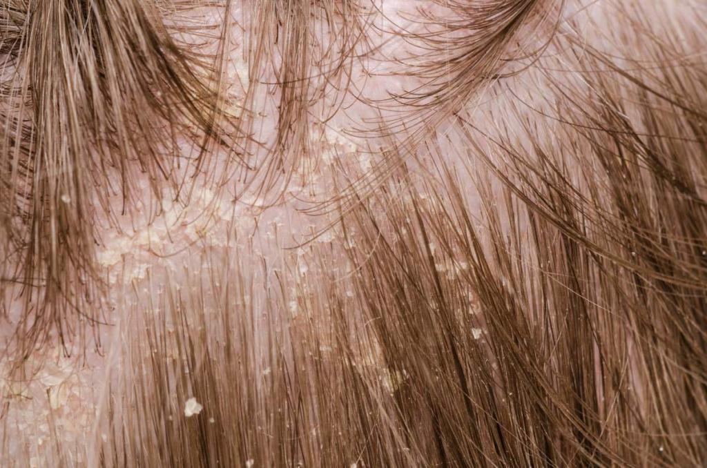 Причины и профилактика себореи кожи головы
