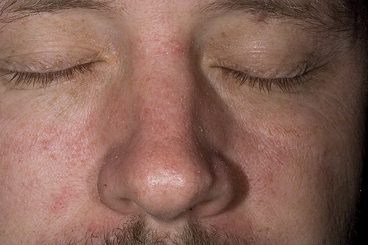 Себорея (acne vulgaris). диагностика и лечение | альтермед