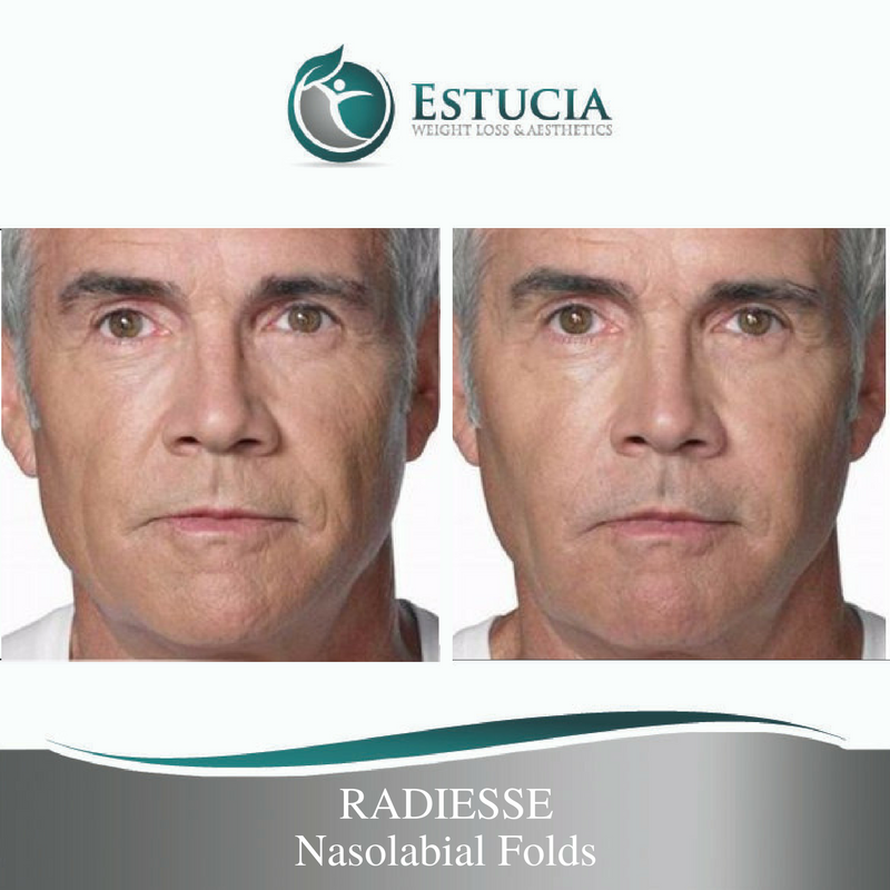 Radiesse — препарат для контурного моделирования на основе гидроксиапатита кальция