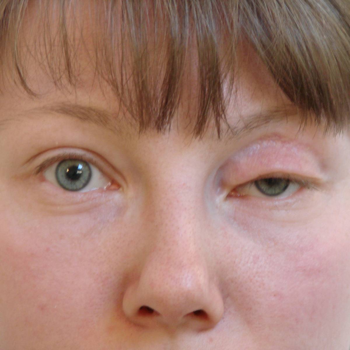 Отекшие глаза причины и лечение у женщин. Экзофтальм анизокория. Блефароптоз верхнего века.