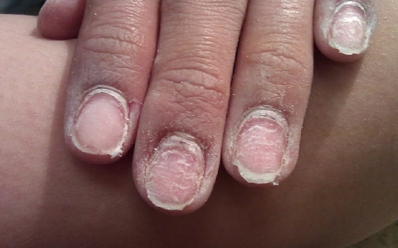 Как восстановить ногти после наращивания: салонные процедуры и домашний уход