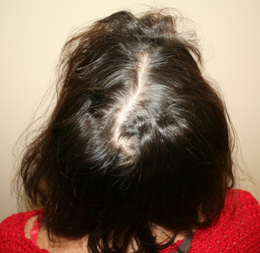 Диффузное выпадение волос у женщин