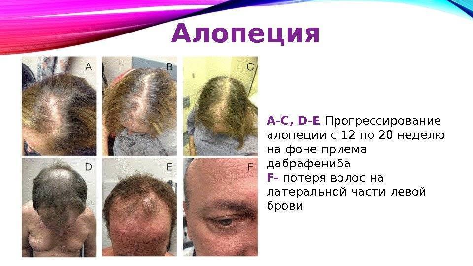 Алопеция, или выпадение волос!
