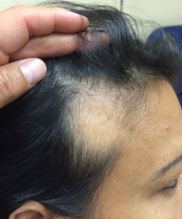 Очаговое облысение у женщин, причины очагового выпадения волос у женщин