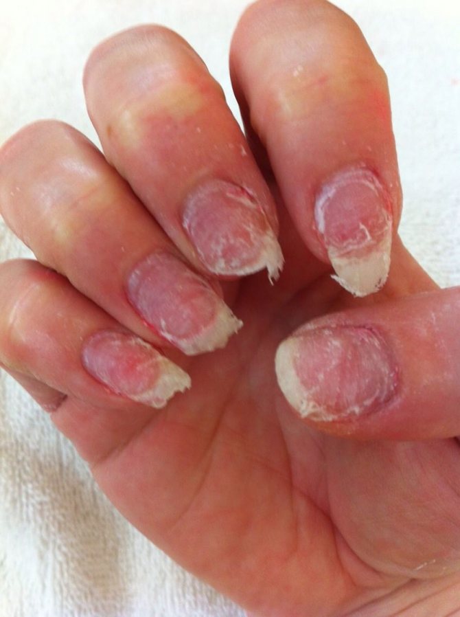 Восстанавливающие процедуры для ногтей после наращивания
